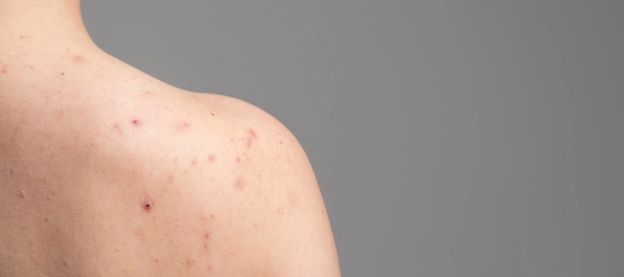 Imagem do post Espinha nas costas? Por que surgem e como evitar? 