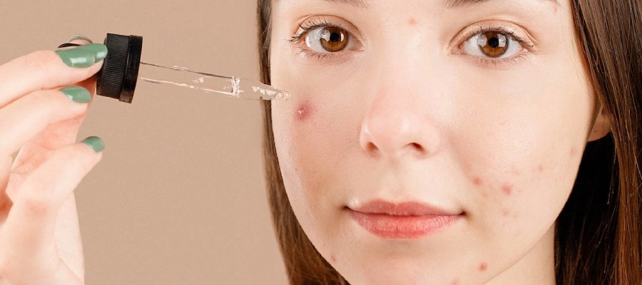 Imagem do post Como evitar espinhas na adolescência? 3 segredos que REALMENTE funcionam 