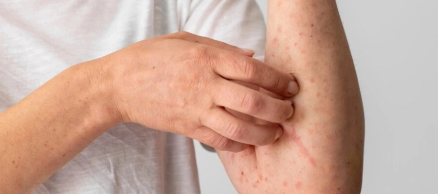 Imagem do post Como tratar bolinhas na pele? Veja dicas e produtos eficazes