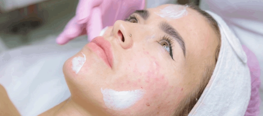 Imagem do post Como tratar cicatriz de acne: conheça 5 procedimentos