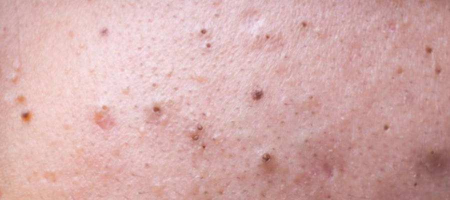 Imagem do post O que causa cravo no rosto? Conheça os 5 vilões da pele! 