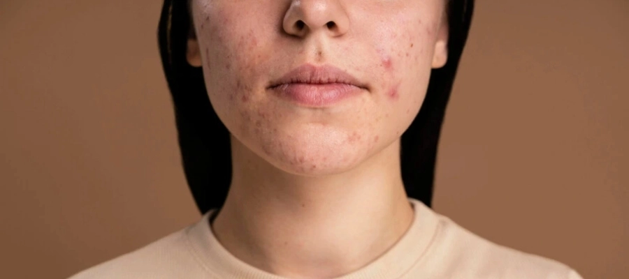 Imagem do post Tipos de acne: quais são os mais comuns e como prevenir?