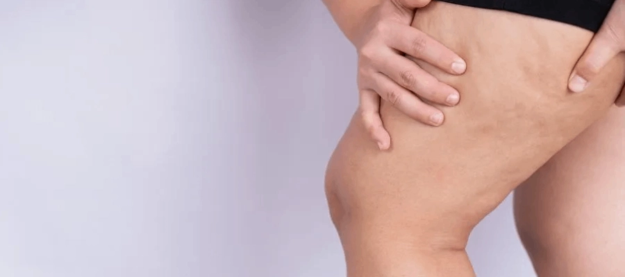 Imagem do post Celulite tem cura? Quais são os graus? Como surge no corpo?