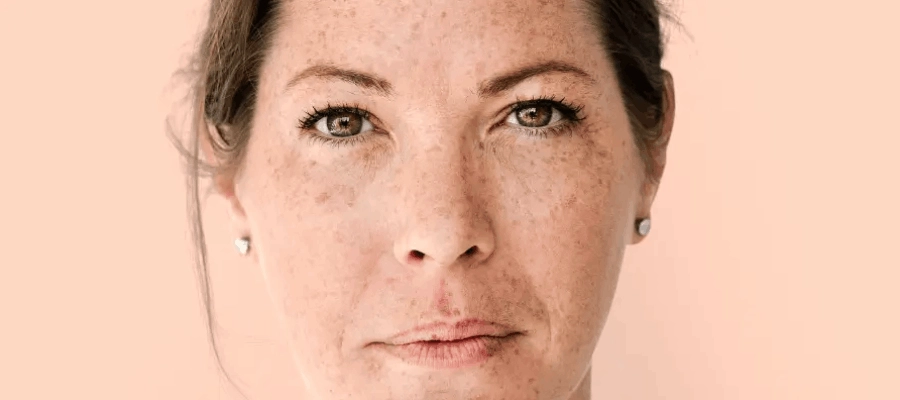 mulher com pequenas manchas escuras na pele olhando para a câmera