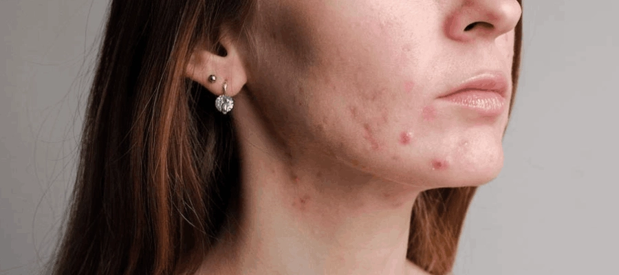 Imagem do post Sabonete Glycare: conheça os tipos e aprenda como usar