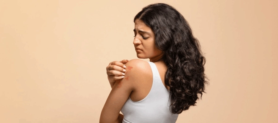 Mulher com dermatite atópica coça seu ombro e apresenta vermelhidão na pele.