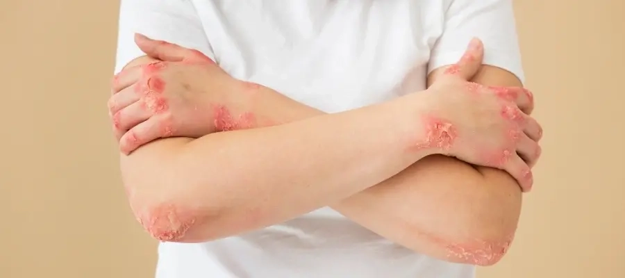  Mulher aplica creme no rosto e testa para que serve o hidratante restaurador