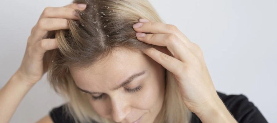 Imagem do post Dermatite seborreica no couro cabeludo: sintomas e tratamentos
