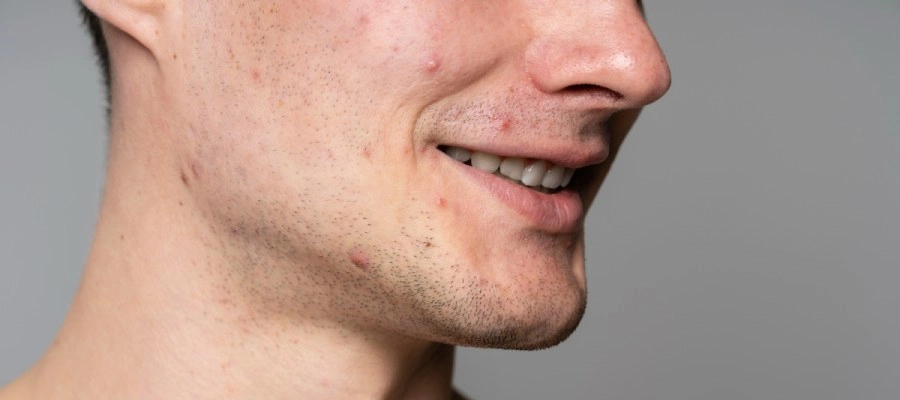 Imagem do post Homem com espinha: até que idade ocorre esse problema na pele? 