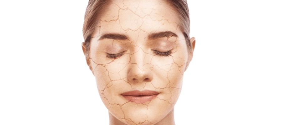 Rosto feminino com rachaduras e ressecamento para representar a desidratação cutânea.