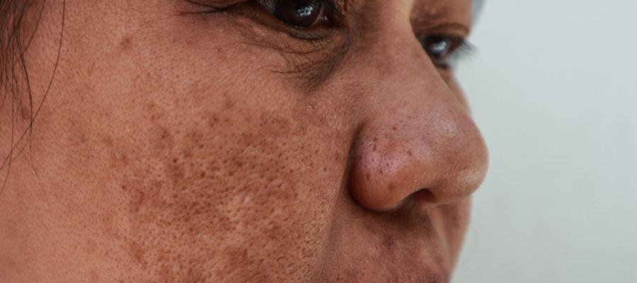 Imagem do post O que causa melasma no rosto? Tipos e principais tratamentos