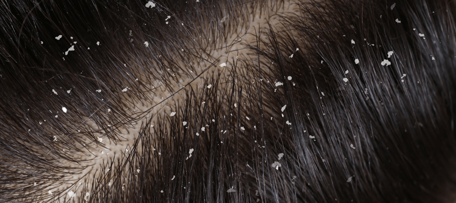 Imagem do post Quem faz progressiva pode usar shampoo anticaspa? 4 dicas para cuidar do cabelo