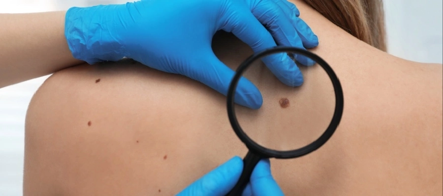 Dermatologista examina sinal suspeito nas costas de paciente e avalia sintoma do câncer de pele