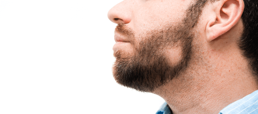 Imagem do post Tudo que você precisa saber sobre alopecia na barba: das causas aos tratamentos
