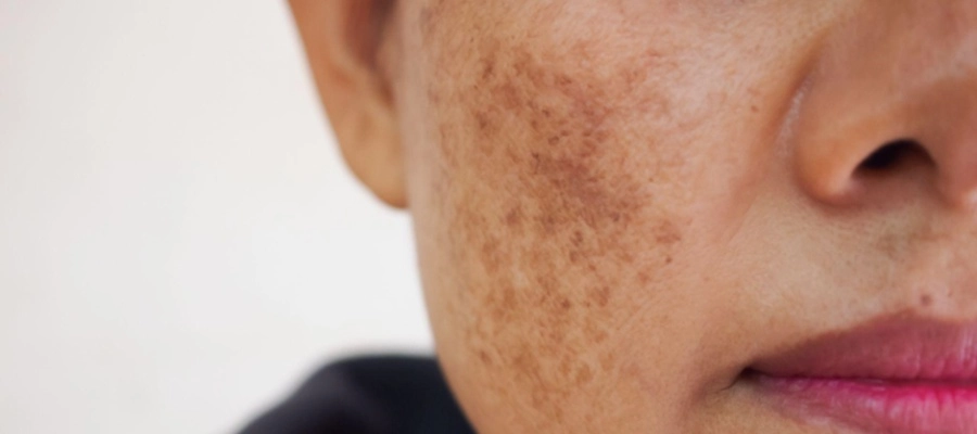 Imagem do post Clareador de manchas na pele: entenda como esse tratamento funciona