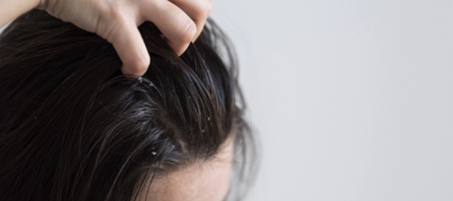 Imagem do post Como acabar com a caspa e ter um couro cabeludo saudável?