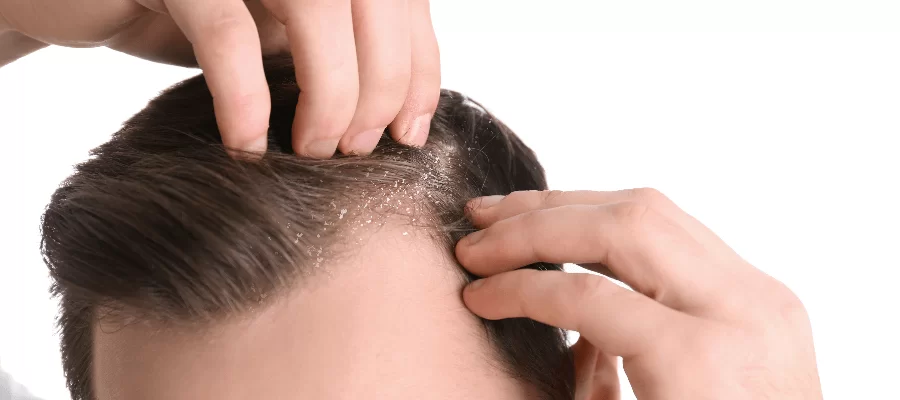 Imagem do post 3 dicas práticas e eficazes de como controlar a caspa do cabelo masculino