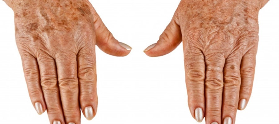 Imagem do post Manchas escuras no dorso da mão: entenda como prevenir e tratar