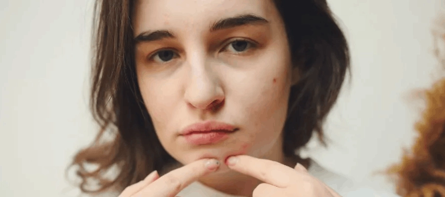 Imagem do post Acne na adolescência: o que realmente funciona? [GUIA]
