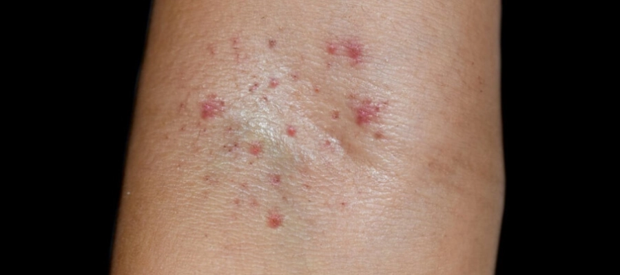 Imagem do post Como são as manchas da dengue? Como identificá-las?