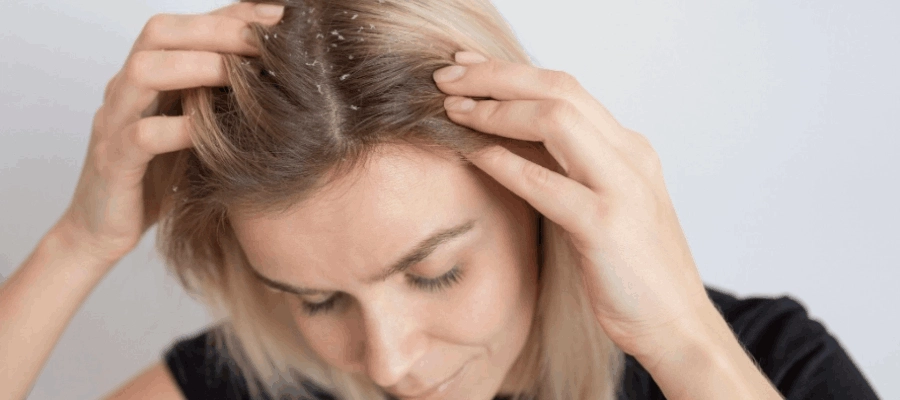 Imagem do post O que é bom para caspa? Como escolher o melhor shampoo?