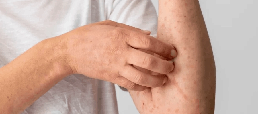 Imagem do post Foliculite infecciosa: o que é? Quais as causas? Como tratar?