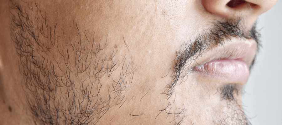 Imagem do post Conheça 3 soluções práticas para disfarçar a falha na barba!