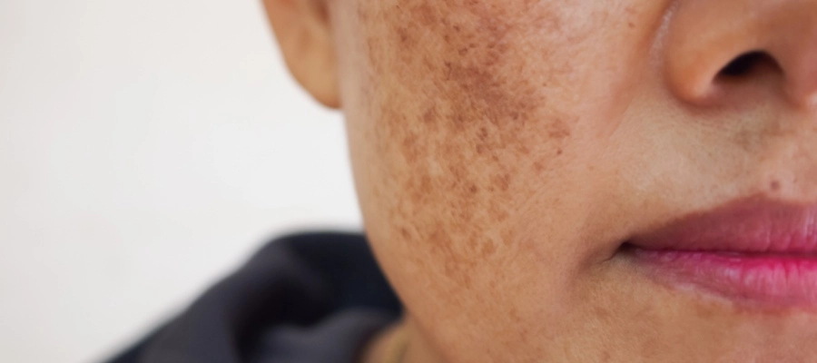 Imagem do post Como evitar manchas no rosto? Aprenda a se prevenir!