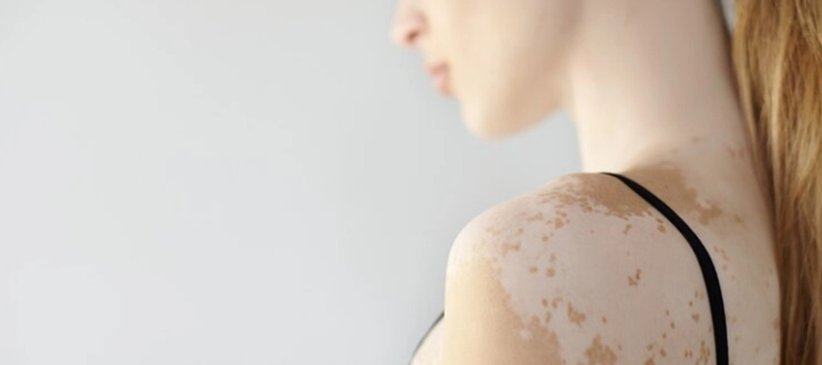 Imagem do post O que causa mancha branca na pele? 9 causas comuns da hipopigmentação
