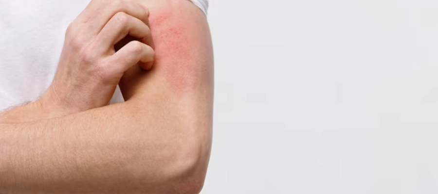 Imagem do post Manchas vermelhas na pele: tipos, causas, sintomas associados e mais!