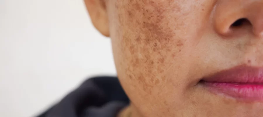 Imagem do post O que é melasma na pele? Quais os tipos? Como tratar?