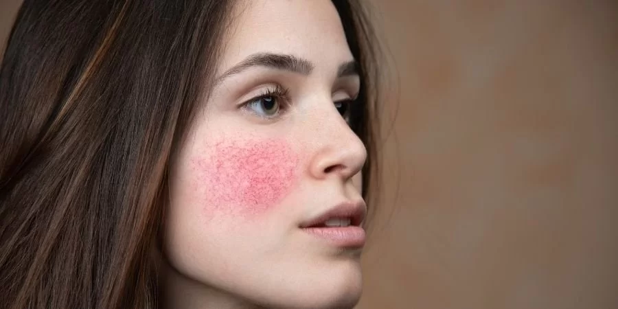 Imagem do post O que é uma pele irritada? Conheça 4 dicas de como prevenir